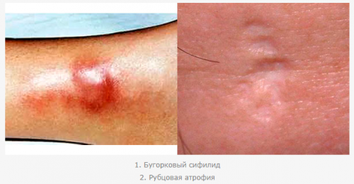 Бугорковый сифилид и рубцовая атрофия