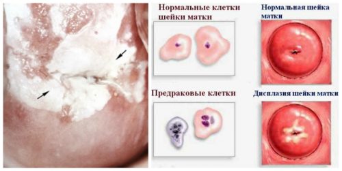 Схема дисплазии шейки матки