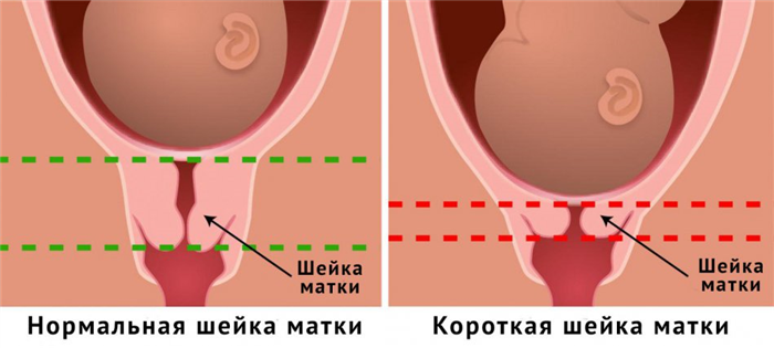 Короткая шейка матки при беременности
