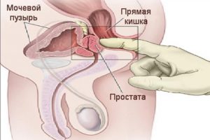 Массаж простаты