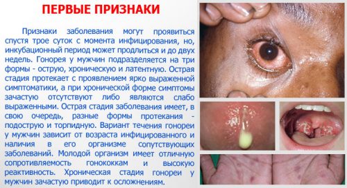 Признаки гонореи у мужчин