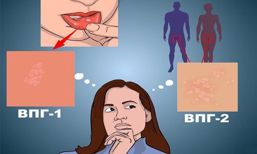 Разновидности ВПГ