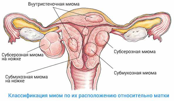 Классификация миом