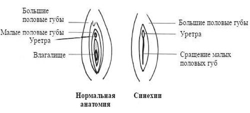 Синехии половых губ