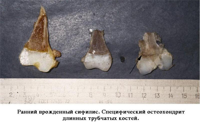 Ранний врожденный сифилис