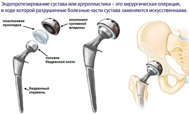 Эндопротезирование