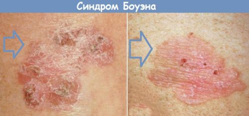 Синдром Боуэна