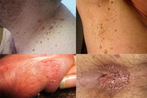 Локализация новообразований