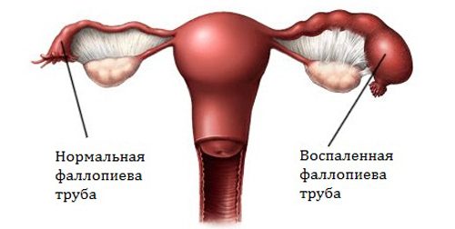 Воспаление при оофорите