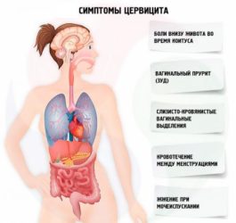 Симптомы цервицита