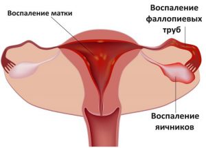 Воспалительные процессы