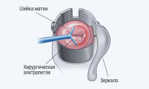 Схема прижигания эрозии шейки матки