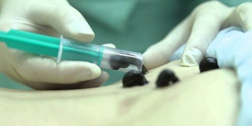 Лечение печени пиявками
