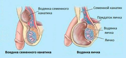 Гидроцеле или водянка яичка