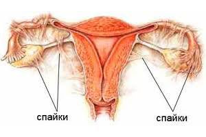 Возникновение спаек