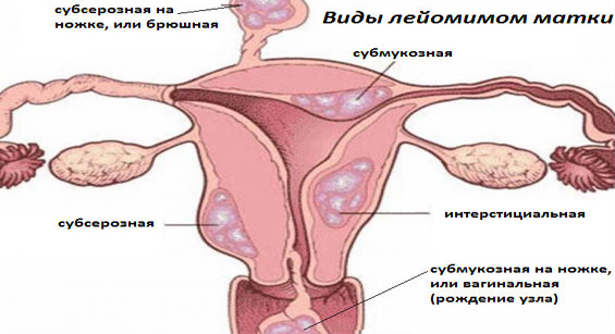 Разновидности лейомиоматозных узлов