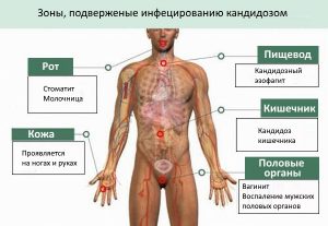Локализация кандидоза