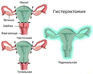 Гистерэктомия матки