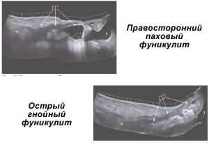 УЗИ при фуникулите