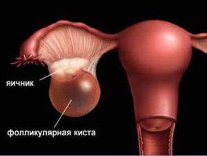 Фолликулярная киста яичника