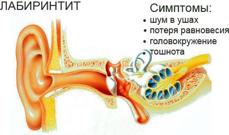 Основные симптомы лабиринтита