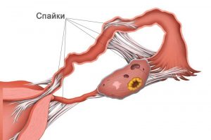 Спайки в маточных трубах