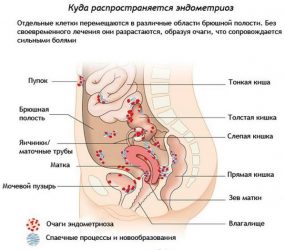 Очаги заболевания