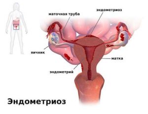 Схема эндометриоза