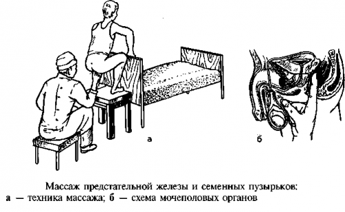 Массаж предстательной железы