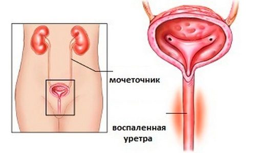 Воспаление уретры