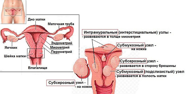 Узлы миомы матки