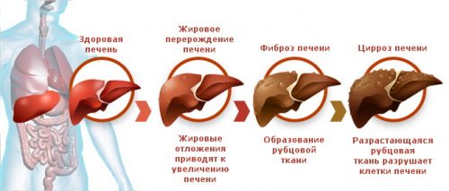 Поражение печени при гепатите