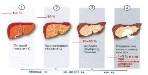 Стадии гепатита С