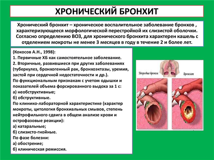 Хронический бронхит