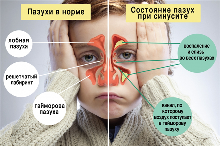 Пазухи ребенка в норме и при синусите
