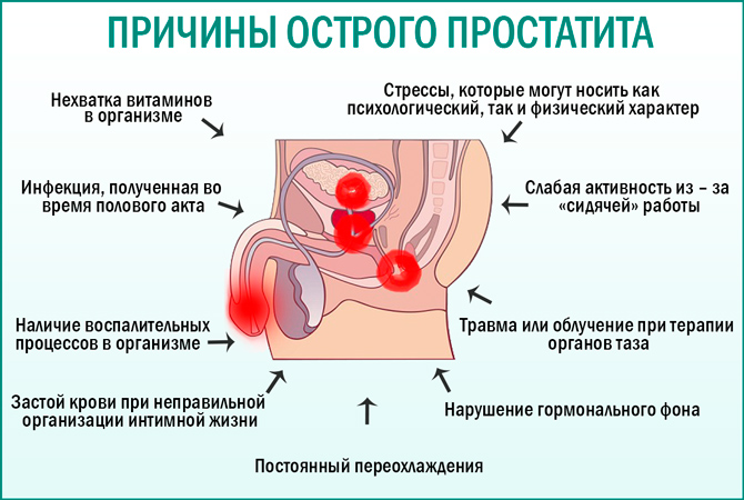 Причины острого простатита