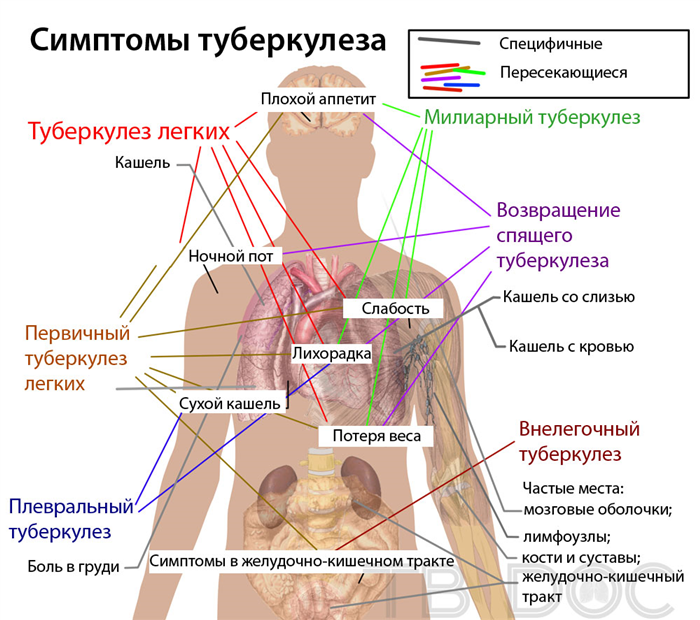 Симптомы и лечение туберкулеза