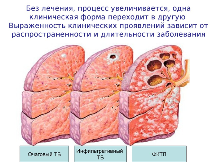 Симптомы и лечение туберкулеза