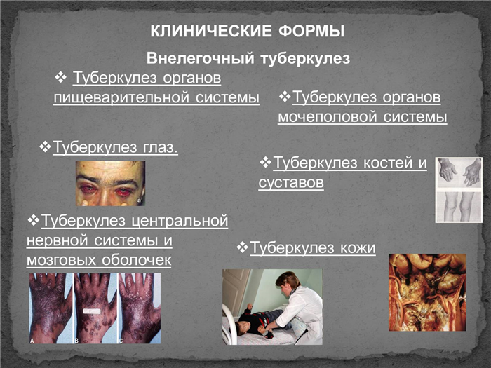 Симптомы и лечение туберкулеза