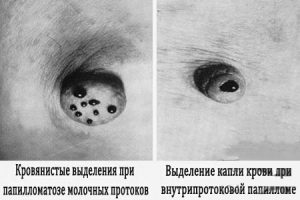 Выделения из соска
