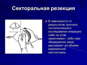 Секторальная резекция