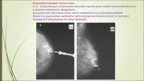 Внутрипротоковые папилломы на снимке