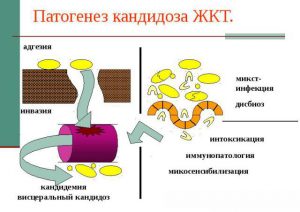 Патогенез кандидоза ЖКТ