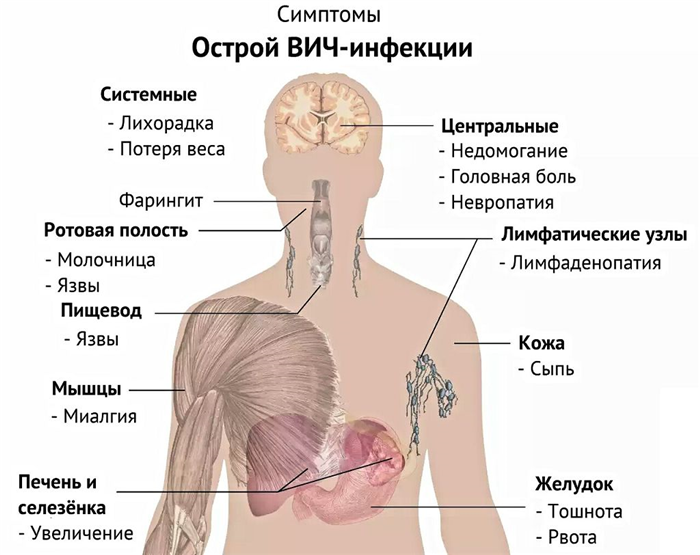 Симптомы острой ВИЧ-инфекции