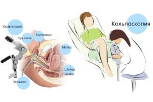 Проведение кольпоскопии