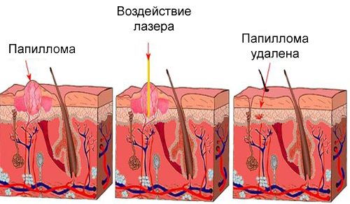Схема лазерного удаления папилломы