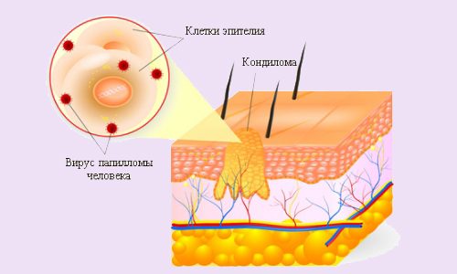 Схема кондиломы