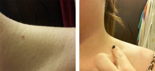 Результат применения Суперчистотела