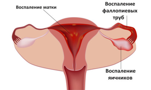 Когда симптоматика сохраняется дольше 3 дней это может указывать на то, что воспалительный процесс распространился на репродуктивные органы