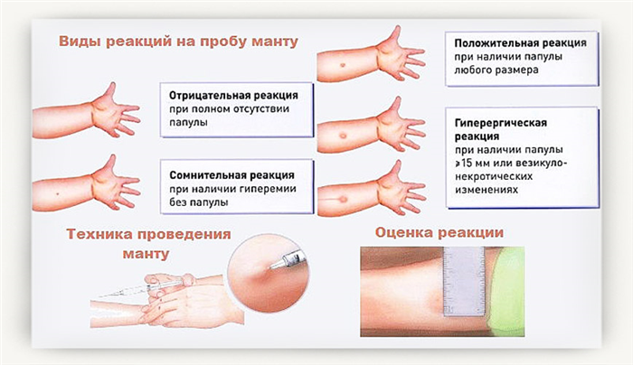 Виды реакций на пробу манту